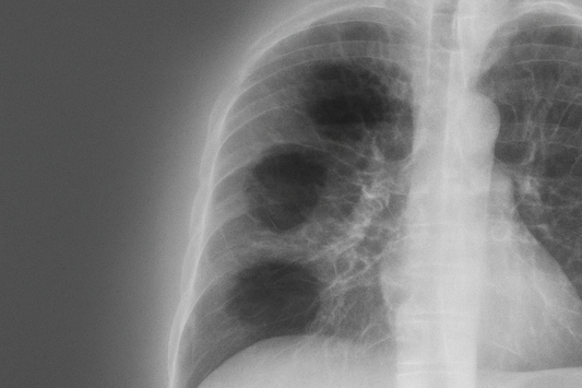 Pulmonary Fibrosis Explained: Breathing in a Stiffening World